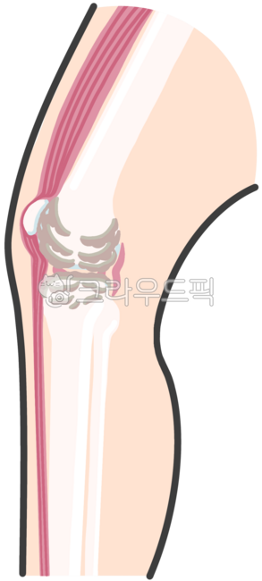 관절,무릎,관절염,정형외과,관절수술,인공관절,퇴행성,퇴행성관절염,관절염진행,무릎뼈,뼈,인체,다리,염증,노화,관절노화