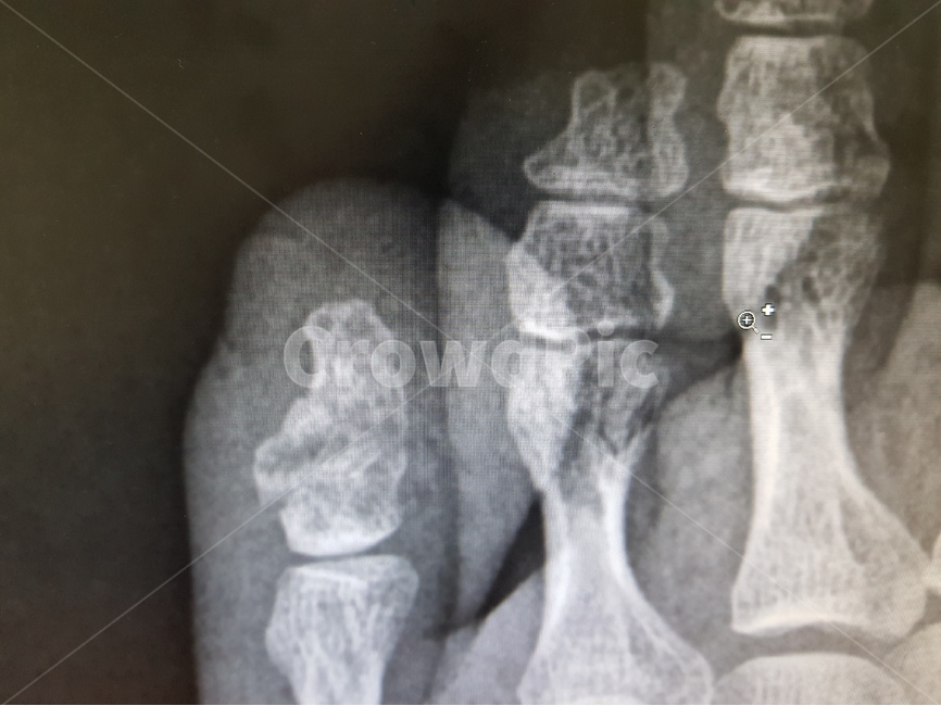 xray,병원,골절,발가락,뼈,의료,치료,환자,기브스,보험,건강,건강보험,안전사고,과실,의료,의학,병원,medical,hospital,clinic