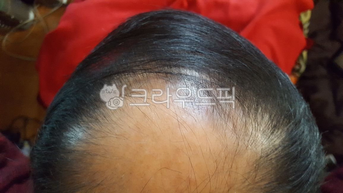 정수리,탈모,대머리,모발이식,모발문신