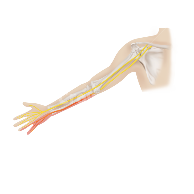 메디컬,medical,png,일러스트,메디컬일러스트,척골신경,신경,염증,마비,증상,병증,누끼,remove background