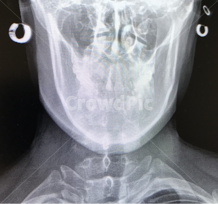 xray,엑스레이,해골,skull,peircing,피어싱,의료,의학,병원,medical,hospital,clinic