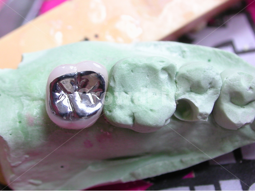 Technician,Dentist,Medical treatment,implant,gypsum,molar,dental,prosthetics,dental technician,teeth,plastic surgery