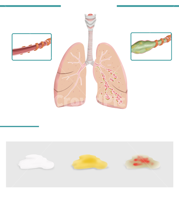 medical,disease,form,sputum,step,illustration,bronchiectasis,bronchi