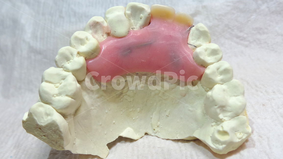 치과,의치,치아,임시치아,가의치,석고,모형,dental,temporary,구강장치,기공사,의료,의학,병원,medical,hospital,clinic
