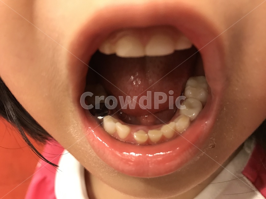이,mouth,입,충치,치료,신체일부,몸,body