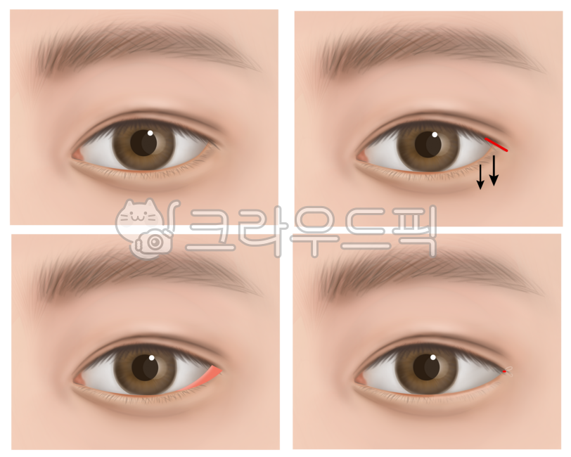 의학,해부학,메디컬일러스트,메디컬,일러스트,눈,눈동자,성형,수술,성형수술,뒷트임,그림