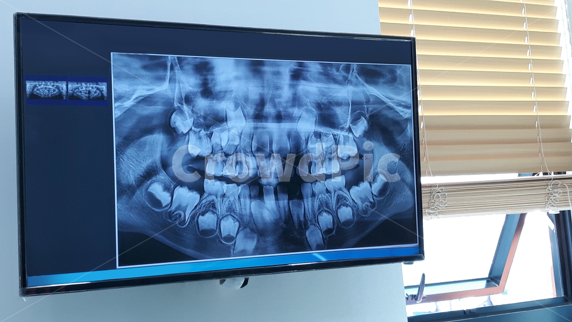 엑스레이,xray,치아,치과,입,화면,모니터,얼굴,이,어린이,블라인드,창문,덴탈,뼈,크리닉,덴티스트,건강,메디컬,병원,필름,사진