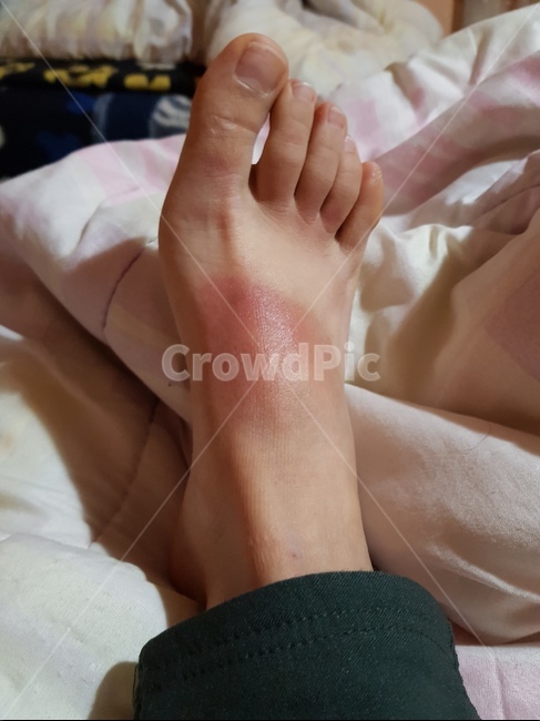 햇빛화상,자외선,발,선탠,화상