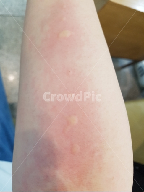 알레르기,알레르기검사,검사,allergy,hives,사람,인물,인간,human,person,신체일부,몸,body,의료,의학,병원,medical,hospital,clinic