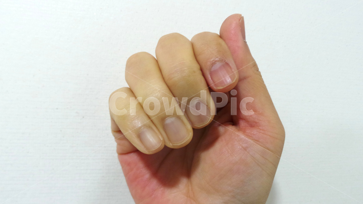 레이노병,레이노증후군,피부병,의학,레이노,손,손가락,혈관,hand,혈관병,피부,살,수족냉증,Raynaud,신체일부,몸,body