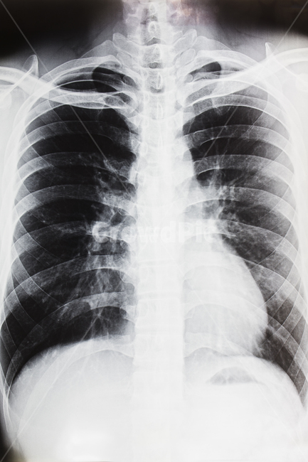 엑스레이,사진,의료,의료보험,xray,뼈,사고,교통사고