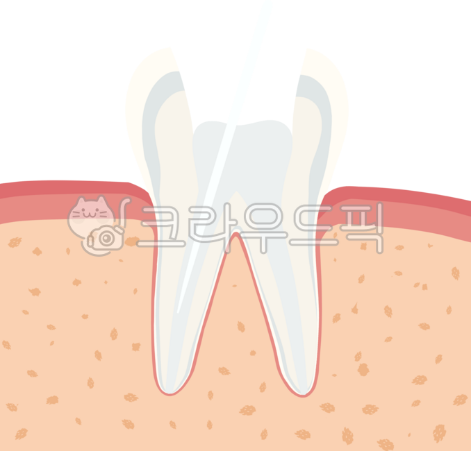 Molar,cavity,root canal,tooth,dentistry,inflammation,crown,inlay,resin,cervical area,abrasion,gums,periodontitis