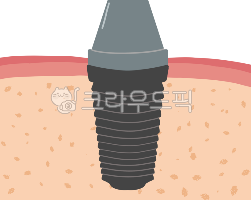 Implant,Crown,Teeth,Dentistry,Bridge,Treatment,Gums,Sutures,Gum Inflammation,Periodontium,Alveolar Bone,Secondary,Molar,Zirconia