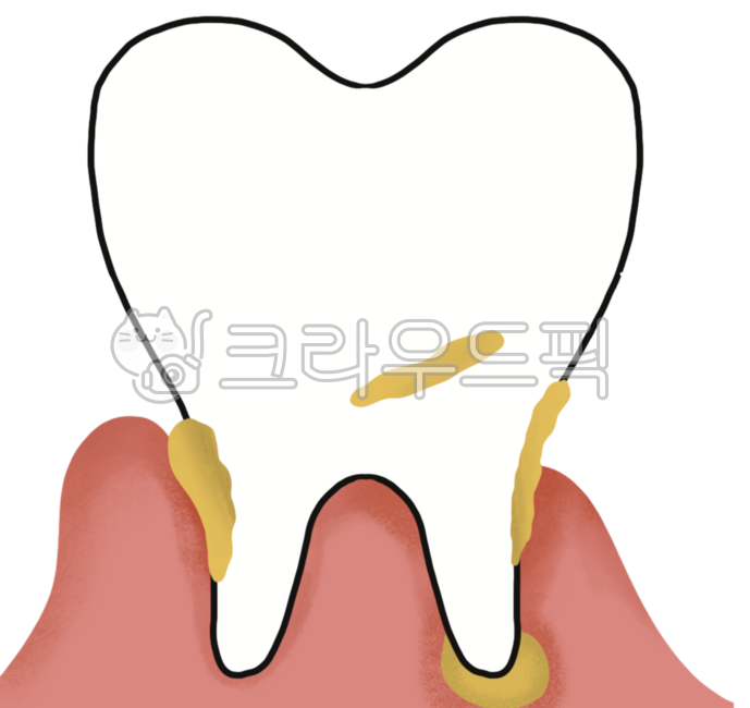 gingivitis,Dentist,Gum illustration,porketdepth,dental disease,periodontal disease,gingiva,teeth,Tooth illustration,tartar,tooth root,dental treatment,Periodontal disease symptoms,gum disease,Subperiodontal,periodontal injury,periddontitis,periodontitis,o
