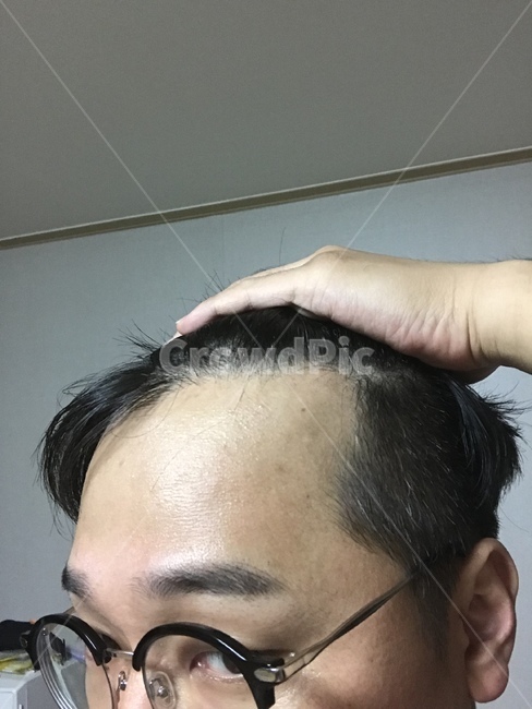 탈모,m탈모,머리,두피,남성탈모,남성형탈모,의료,의학,병원,medical,hospital,clinic