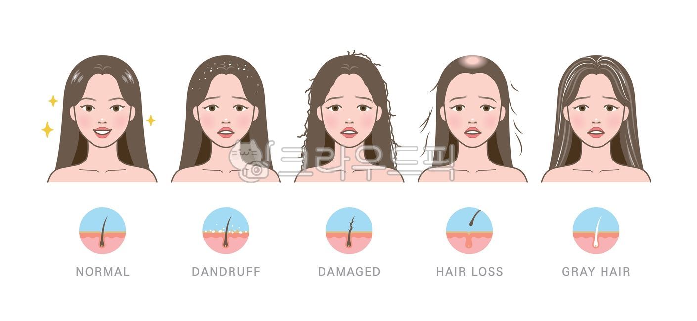머리,머리카락,모발,머릿결,빠짐,탈모,원형탈모,머리빠짐,풍성한,뺵빽한,머리숱,숱,흰머리,새치,노화,볼륨,문제,손상된,손상모,갈라짐,갈라진,푸석푸석한,푸석한,부스스한,비듬,각질,여자,여성,사람,인물,모델,얼굴,캐릭터,미용,관리,일러스트,비교,세트,예쁜