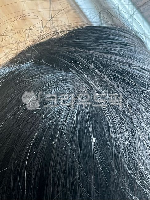 비듬,지루성피부염,각질,두피고민,두피,탈모,hair,머리카락,흑발,blackhair,person,사람,dandruff