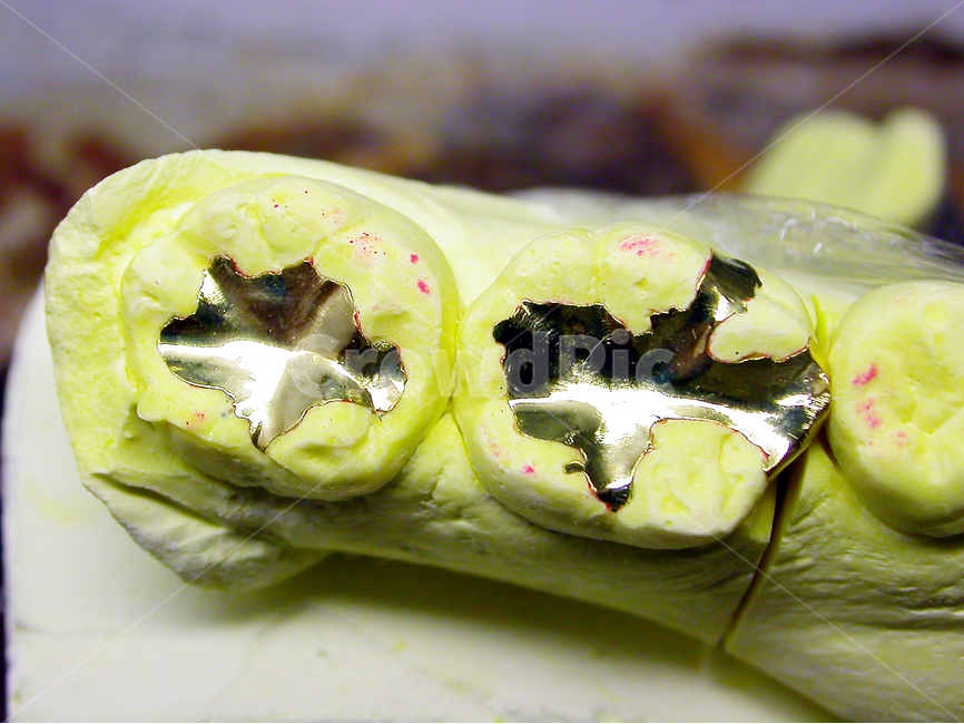 치과,의료,인레이,inlay,치과기공사,골드,치아,이빨,보철,tooth,금,세공,치료,병원,기공,기공사,광택,연마,의료,의학,병원,medical,hospital,clinic,사물,물건,오브젝트,thing,object,matter