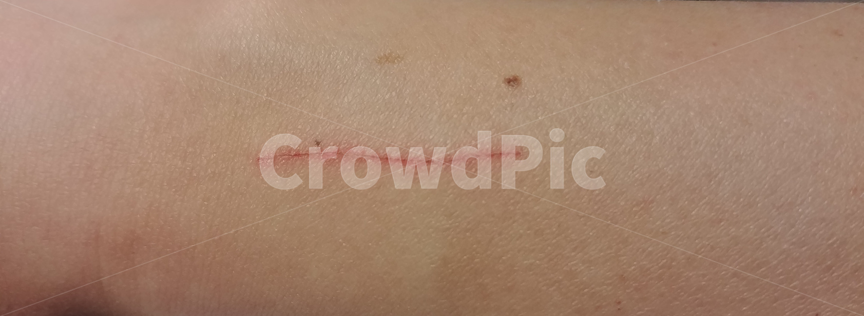피부,상처,skin,살,스크래치,의료,의학,병원,medical,hospital,clinic