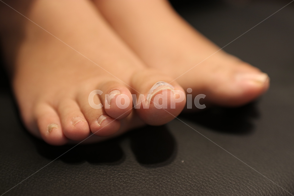 발톱,파고드는발톱,발톱교정,교정기,교정,발톱관리,패디,패디큐어,발,발가락,발끝,사람,인물,인간,human,person,신체일부,몸,body