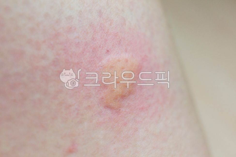 모기,벌레,해충,알레르기,두드러기,발진,피부염,피부과,습진,감염,바이러스,통증,고통,가려움,얼룩덜룩한,표피,수포,물집,상처,손상,염증,클로즈업,rash,hives
