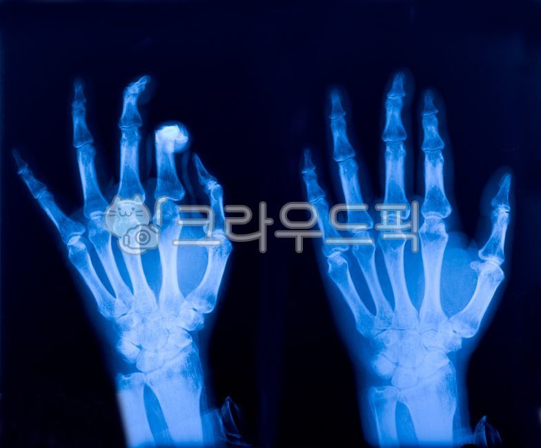 hand bone film,xray,video film,bone,finger film