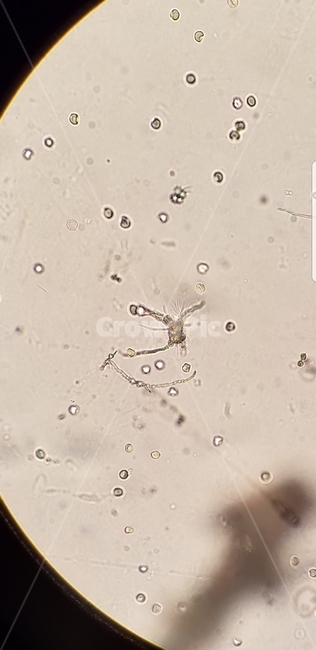 ammoniumbiurates,소변결정체,비우레이트암모늄,소변,결정체,의료,의학,병원,medical,hospital,clinic