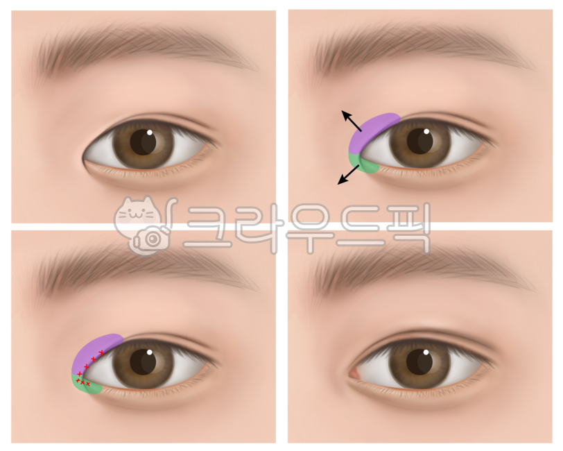 의학,해부학,메디컬일러스트,메디컬,일러스트,눈,눈동자,성형,수술,성형수술,그림,앞트임