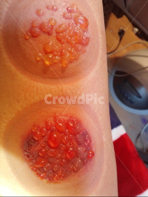 발포부항,물집,부항,독수,요산,혈액정화,기,순환,민간요법,의학,Medical,Cupping,자가요법,수포