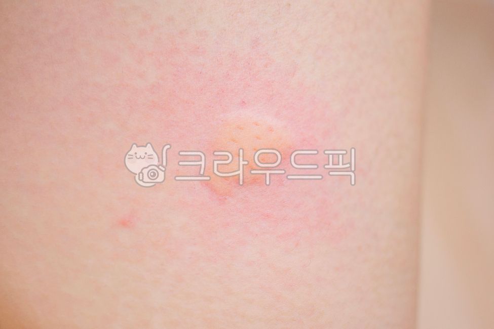mosquito,bug,pest,skin,tickle,skin disease,allergy,hives,rash,skeeter syndrome,itching,stinging,cholinergic,anaphylaxis,acute,hypersensitivity,irritation,adult,body,human,person