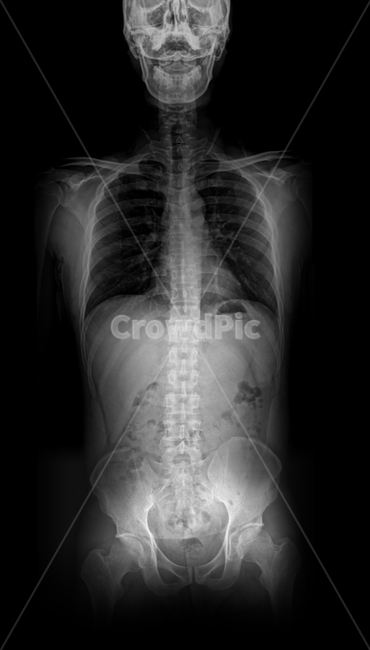 엑스레이,전신엑스레이,뼈,갈비뼈,척추,의료,의학,병원,medical,hospital,clinic