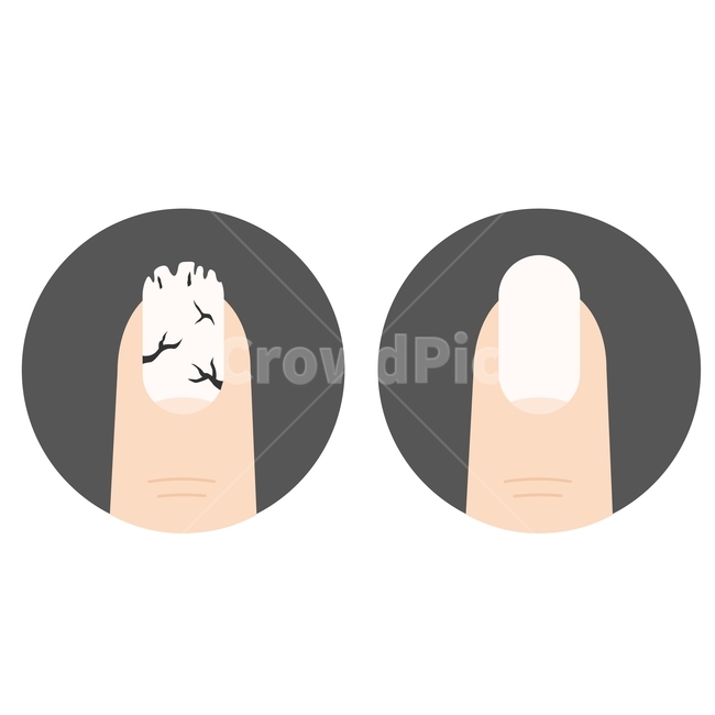 일러스트,손톱,손톱부식,손톱깨짐,건강한손톱,손톱건강,인체,인체건강,건강,손,손가락,그래픽,일러스트레이션,graphic,illustration
