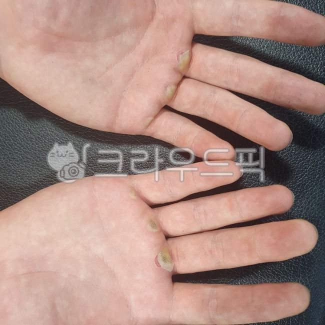 손,손가락,굳은살,턱걸이,고생