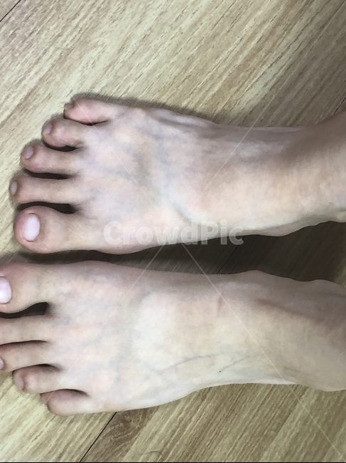 탄발,여름,탄,발,피부