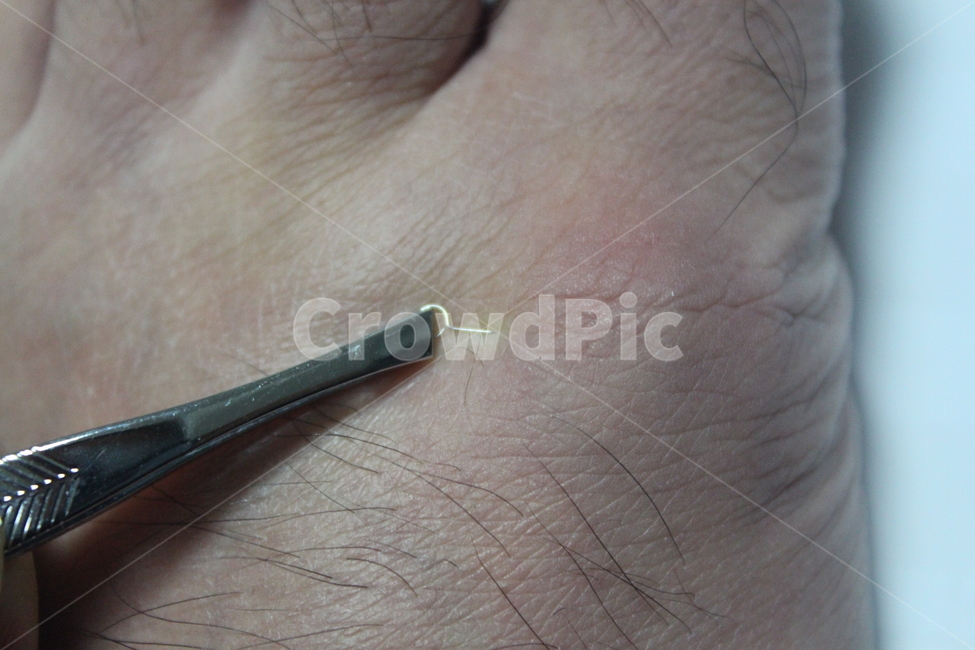 skin,피부,침,피내침,건강,의료,의학,병원,medical,hospital,clinic