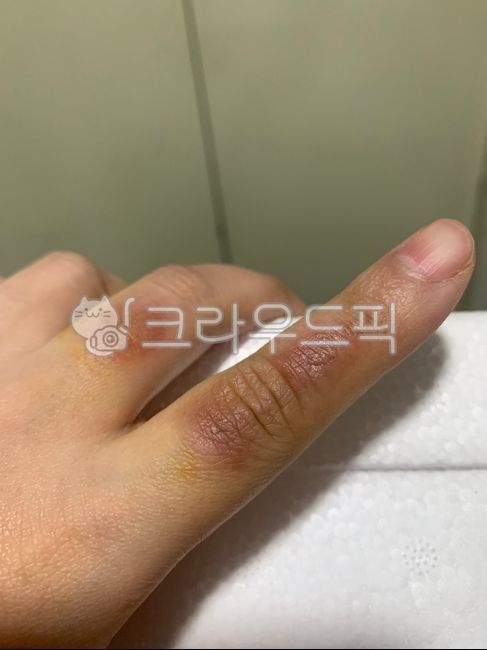 finger,burn,hand burn,blister burn,blister