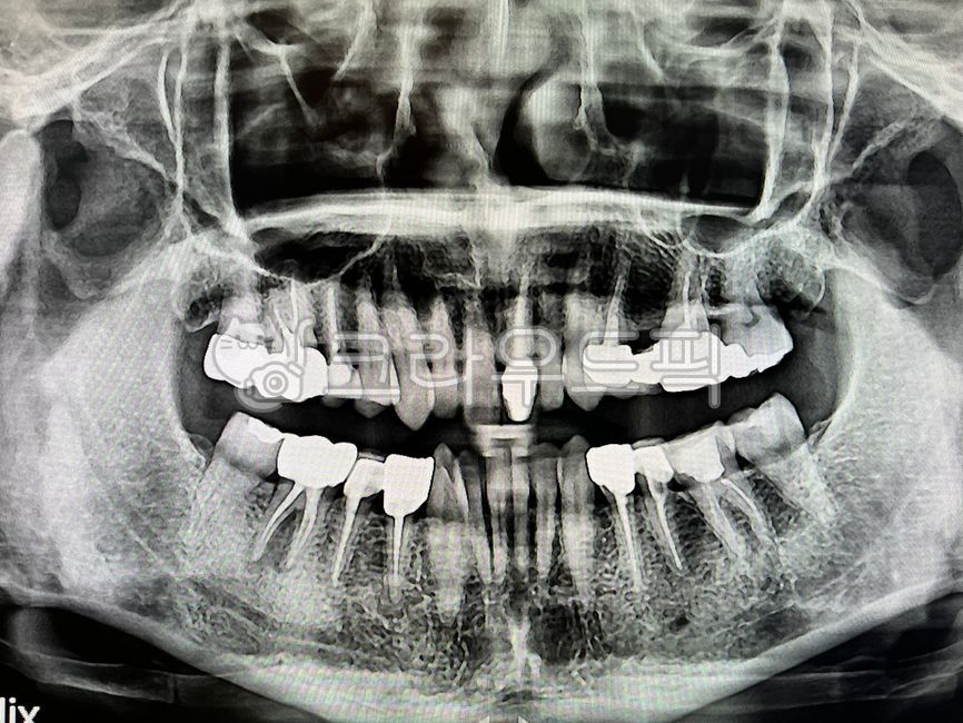 치아,치과,보철,엑스레이,치아엑스레이,xray,뼈,dentistry,이빨