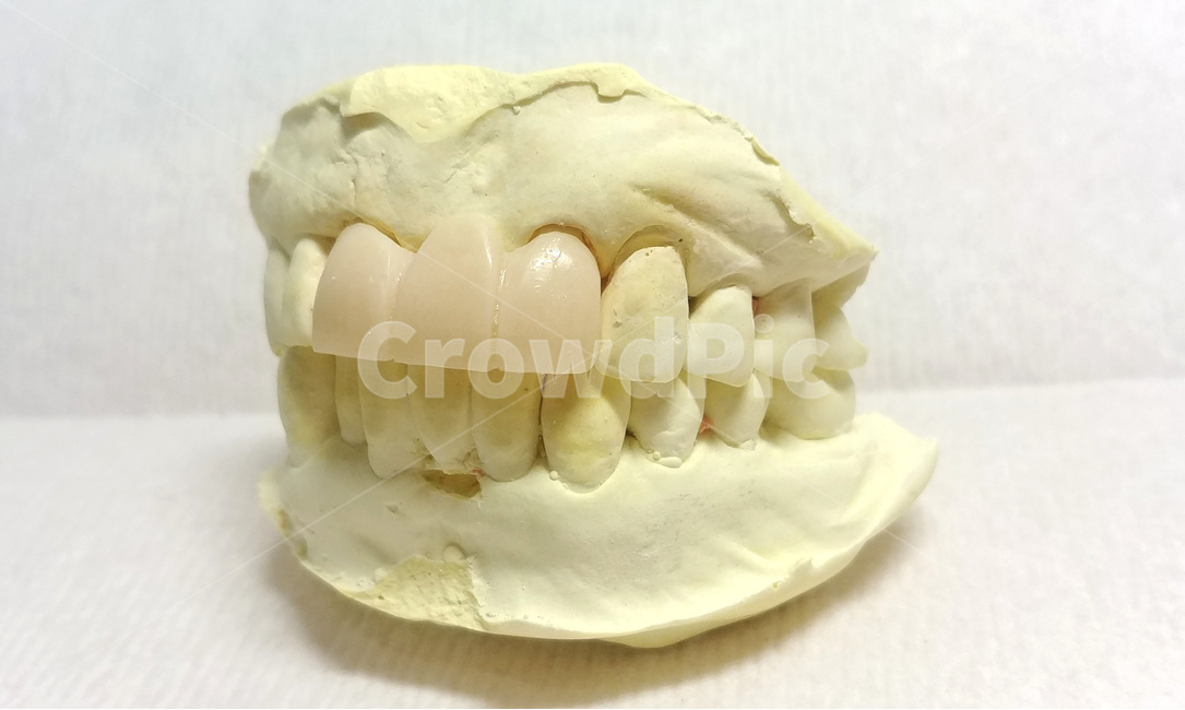 치과,이빨,치아,보철,덴탈,앞니,dental,teeth,임시치아,의료,의학,병원,medical,hospital,clinic