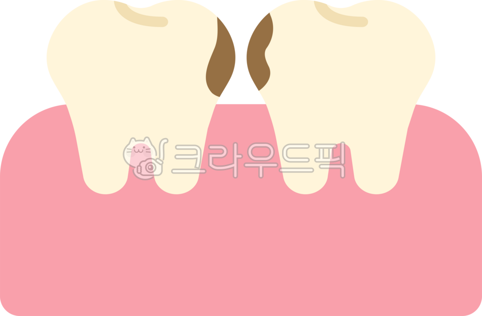 Cavity between teeth,cavity between teeth,cavity between teeth,cavity,upper limit,rotten tooth,shallow cavity,tooth,teeth,dentistry,rotten tooth,rotten tooth,cavity illustration,cavity model,cavity illustration,dental treatment,root canal 