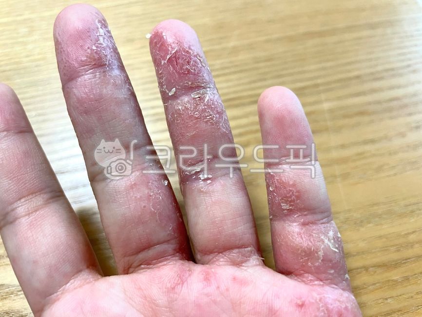 finger,손가락,hand,손,피부병,습진,한포진,주부습진,피부,간지러움,피부습진,피부과,병원,치료,아토피,건선