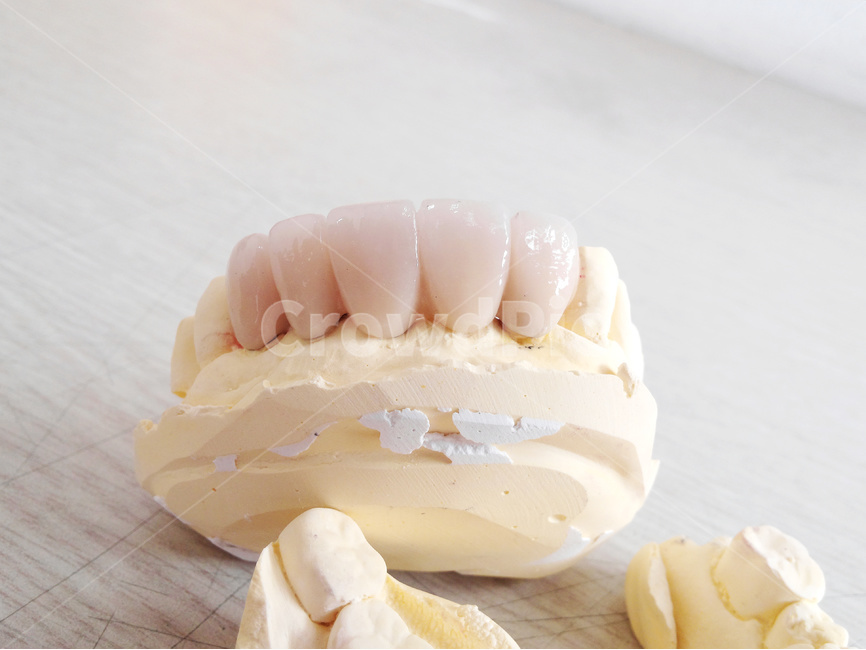 치과,보철,치과기공사,앞니,치아,이빨,porcelain,치과의사,의료,의학,병원,medical,hospital,clinic,사물,물건,오브젝트,thing,object,matter