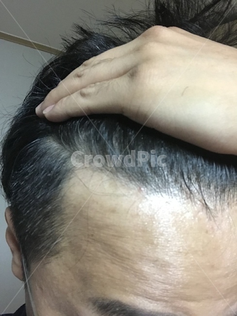 head,머리,탈모,m탈모,남성형탈모,의료,의학,병원,medical,hospital,clinic