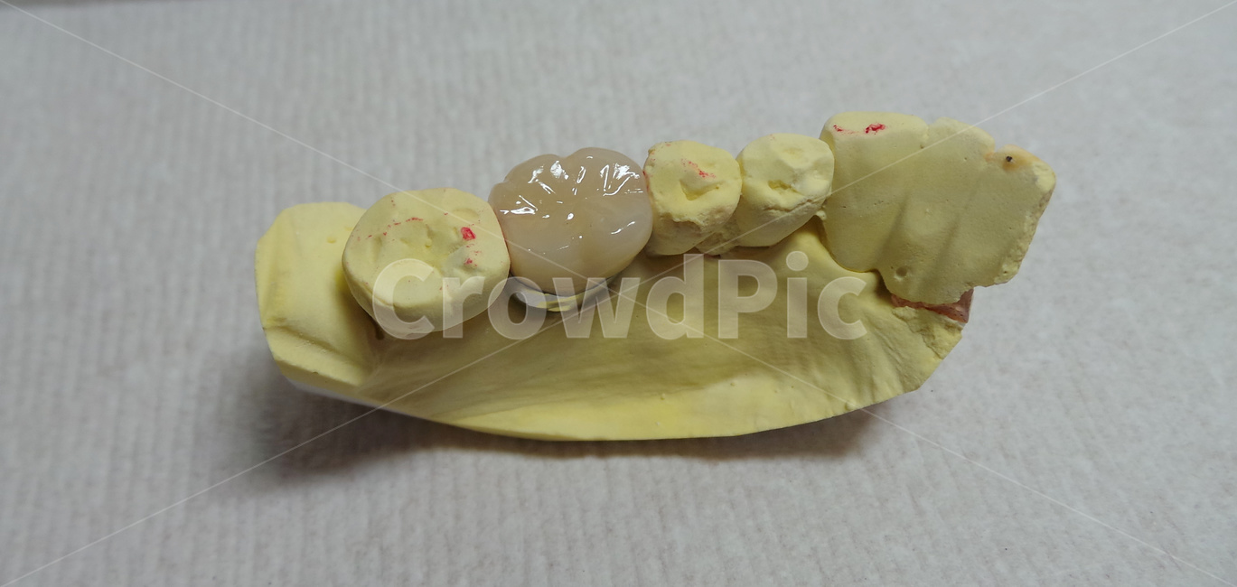 치과,보철,어금니,치과기공사,치아,teeth,보험,porcelain,dental,의료,의학,병원,medical,hospital,clinic
