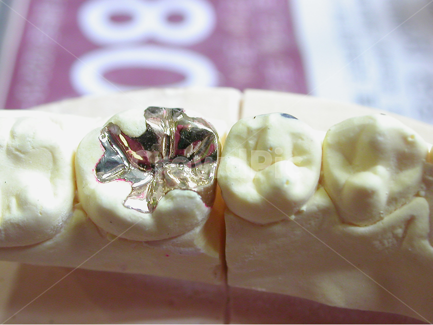 의료,치과,이빨,치아,치과기공,인레이,inlay,어금니,보철,덴탈,보험,의료,의학,병원,medical,hospital,clinic,사물,물건,오브젝트,thing,object,matter