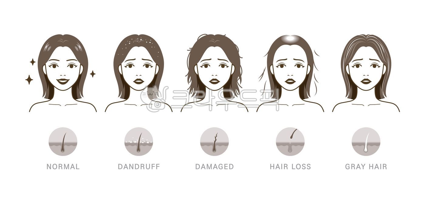 머리,머리카락,모발,머릿결,빠짐,탈모,원형탈모,머리빠짐,풍성한,뺵빽한,머리숱,숱,흰머리,새치,노화,볼륨,문제,손상된,손상모,갈라짐,갈라진,푸석푸석한,푸석한,부스스한,비듬,각질,여자,여성,사람,인물,모델,얼굴,캐릭터,미용,관리,일러스트,비교,세트,예쁜
