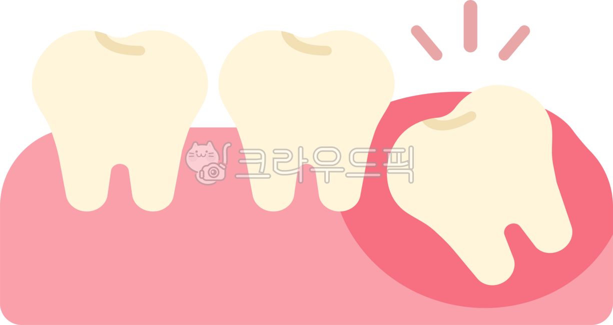 Impacted wisdom tooth,wisdom tooth,wisdom tooth extraction,wisdom tooth extraction,wisdom tooth pain,extraction,wisdom tooth rash,back molar,molar,wisdom tooth removal,dentistry,teeth,teeth,this,wisdomtooth,dental,dentist,tooth,teeth,gu