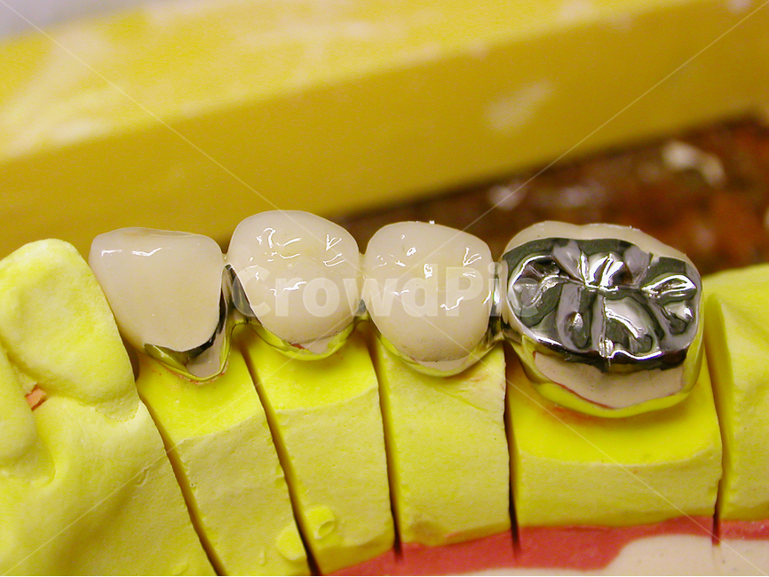 의료,치과,보철,어금니,성형,치아,dental,도자기,포세라인,이빨,치과기공,의료,의학,병원,medical,hospital,clinic,사물,물건,오브젝트,thing,object,matter