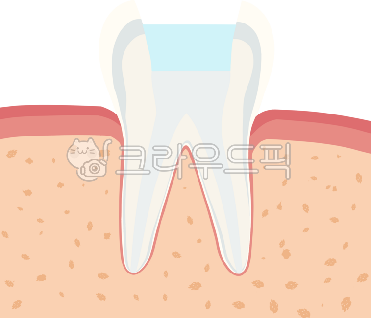 Molar,cavity,root canal,tooth,dentistry,inflammation,crown,inlay,resin,cervical area,abrasion,gums,periodontology