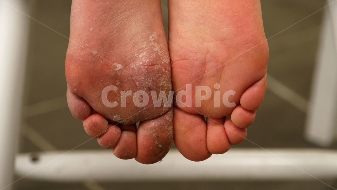 각질,피부,피부트러블,의료,목욕,각질비교,발바닥각질