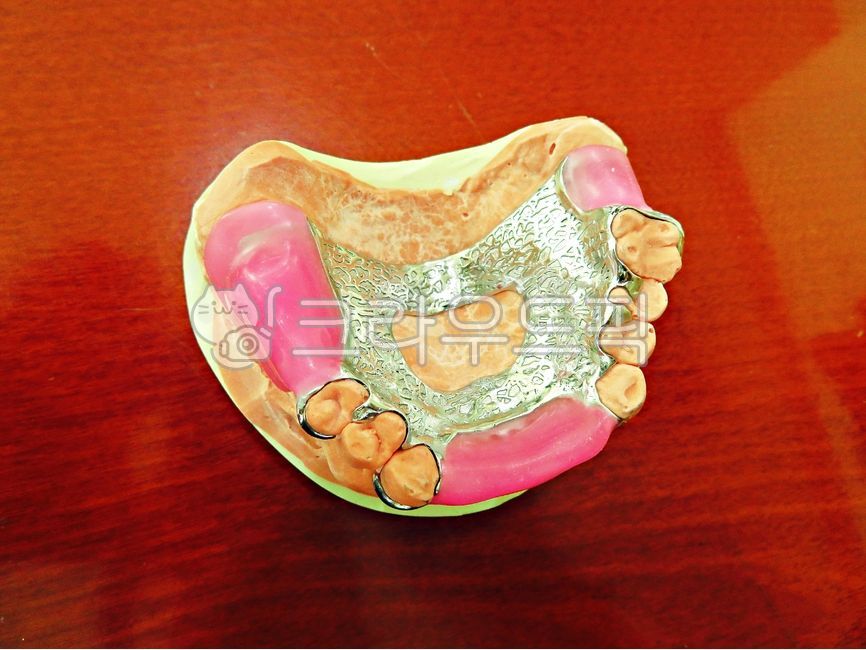 틀니,구강,치과,치과의원,치과의사,치료,진료,치아,상악,금속,프레임,클래스프,왁스,석고,구강보건,보건,의료,의학,치의학,보철,의료보험,보험틀니,denture,insurance,prosthetic,치과기공,oral,health,treatment,teeth,metal,frame,clasp